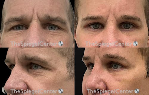 Blepharoplasty Before & After Gallery - Patient 162972 - Image 1