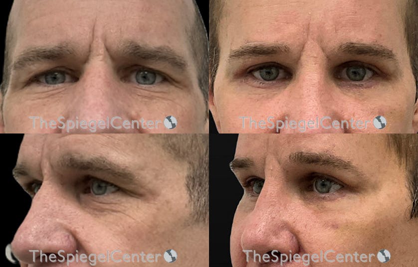 Blepharoplasty Before & After Gallery - Patient 162972 - Image 1