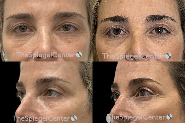 Blepharoplasty Before & After Gallery - Patient 352980 - Image 1