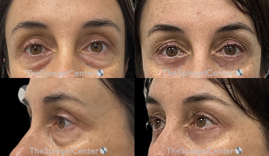 Blepharoplasty Before & After Gallery - Patient 323142 - Image 1