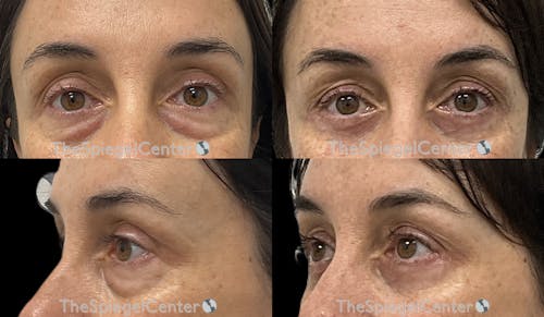Blepharoplasty Before & After Gallery - Patient 323142 - Image 1