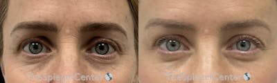 Brow Lift / Fox Eye Lift Before & After Gallery - Patient 251654 - Image 1