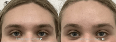Brow Lift / Fox Eye Lift Before & After Gallery - Patient 879212 - Image 1