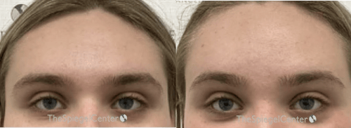 Brow Lift / Fox Eye Lift Before & After Gallery - Patient 879212 - Image 1