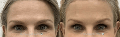 Brow Lift / Fox Eye Lift Before & After Gallery - Patient 264573 - Image 1