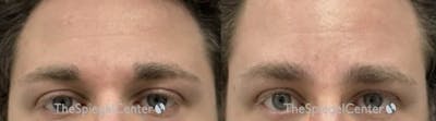 Brow Lift / Fox Eye Lift Before & After Gallery - Patient 384818 - Image 1