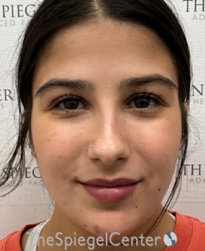 Buccal Fat Reduction Before & After Gallery - Patient 411408 - Image 1
