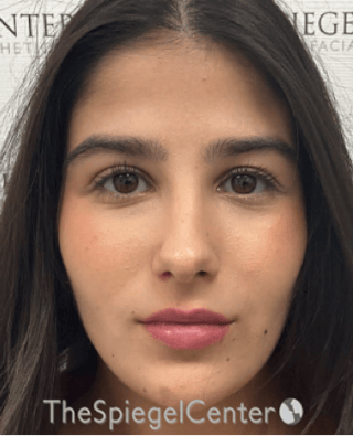 Buccal Fat Reduction Before & After Gallery - Patient 411408 - Image 2