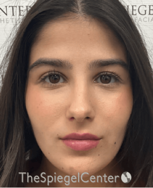 Buccal Fat Reduction Before & After Gallery - Patient 411408 - Image 2