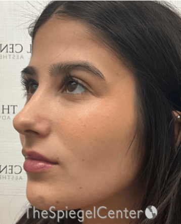 Buccal Fat Reduction Before & After Gallery - Patient 411408 - Image 4