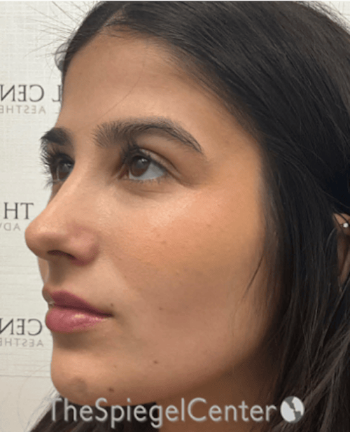 Buccal Fat Reduction Before & After Gallery - Patient 411408 - Image 4