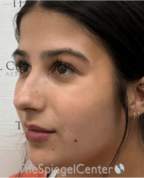 Buccal Fat Reduction Before & After Gallery - Patient 411408 - Image 3
