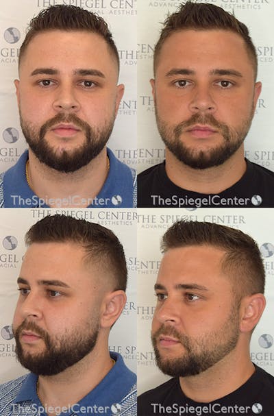 Buccal Fat Reduction Before & After Gallery - Patient 209968 - Image 1