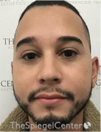 Buccal Fat Reduction Before & After Gallery - Patient 378761 - Image 1