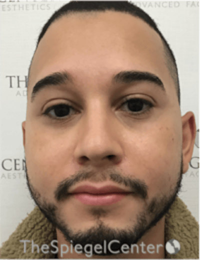 Buccal Fat Reduction Before & After Gallery - Patient 378761 - Image 1