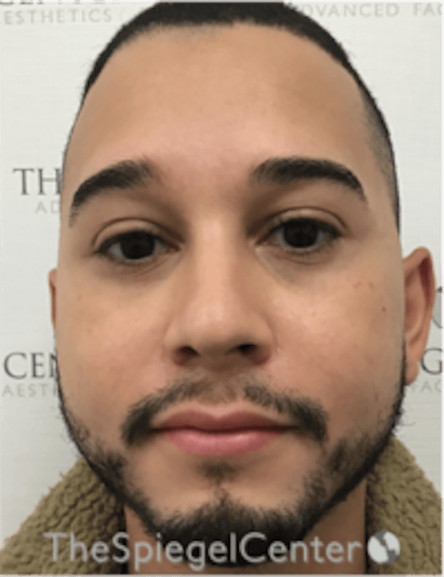 Buccal Fat Reduction Before & After Gallery - Patient 378761 - Image 1