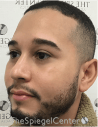 Buccal Fat Reduction Before & After Gallery - Patient 378761 - Image 3