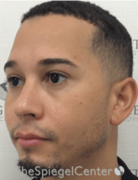 Buccal Fat Reduction Before & After Gallery - Patient 378761 - Image 4