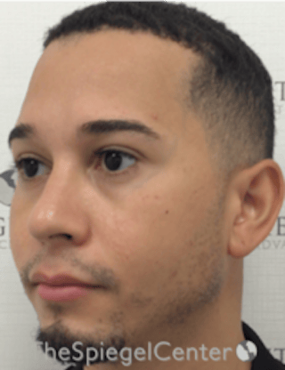 Buccal Fat Reduction Before & After Gallery - Patient 378761 - Image 4