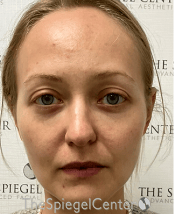 Buccal Fat Reduction Before & After Gallery - Patient 299914 - Image 2