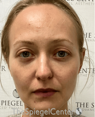 Buccal Fat Reduction Before & After Gallery - Patient 299914 - Image 2