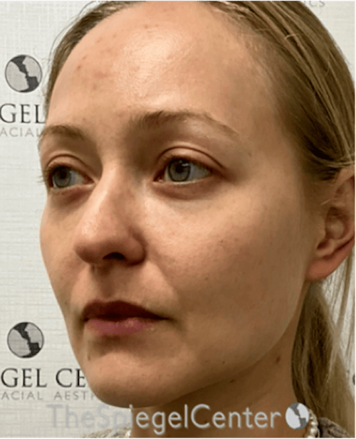 Buccal Fat Reduction Before & After Gallery - Patient 299914 - Image 4