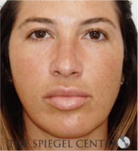 Buccal Fat Reduction Before & After Gallery - Patient 360987 - Image 1