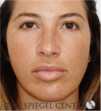 Buccal Fat Reduction Before & After Gallery - Patient 360987 - Image 1