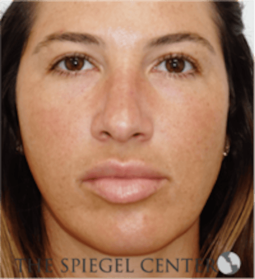 Buccal Fat Reduction Before & After Gallery - Patient 360987 - Image 1