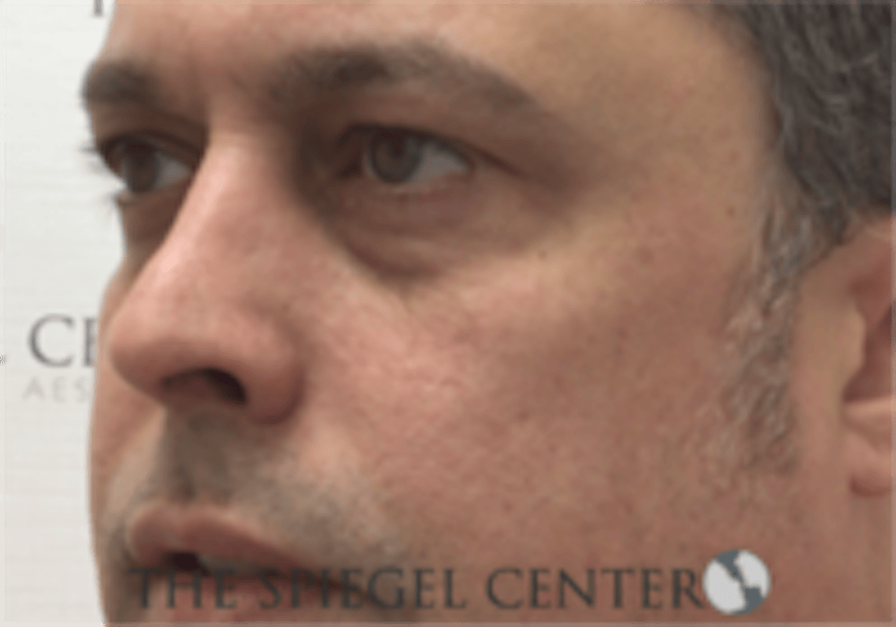 Cheek Augmentation