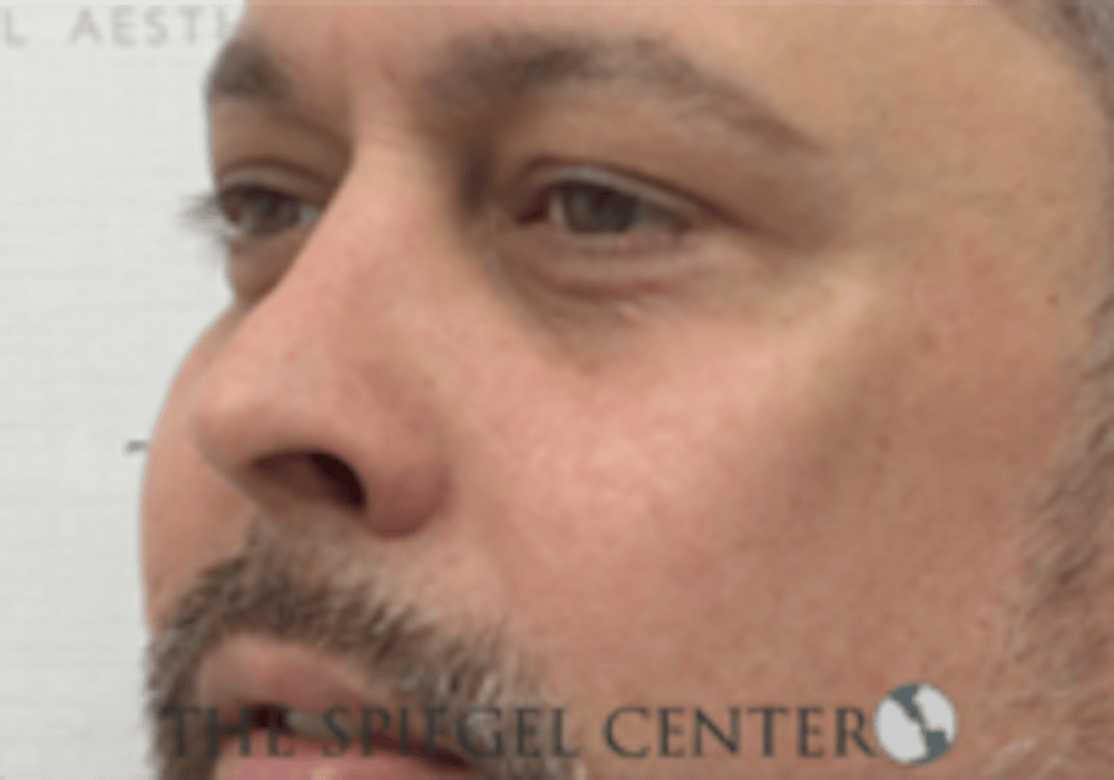 Cheek Augmentation