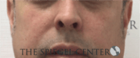 Cheek Implants Before & After Gallery - Patient 442417 - Image 3