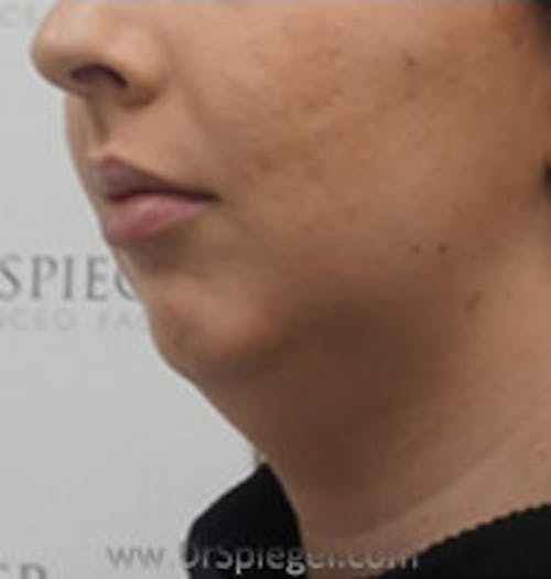 Chin Augmentation Before & After Gallery - Patient 305825 - Image 3