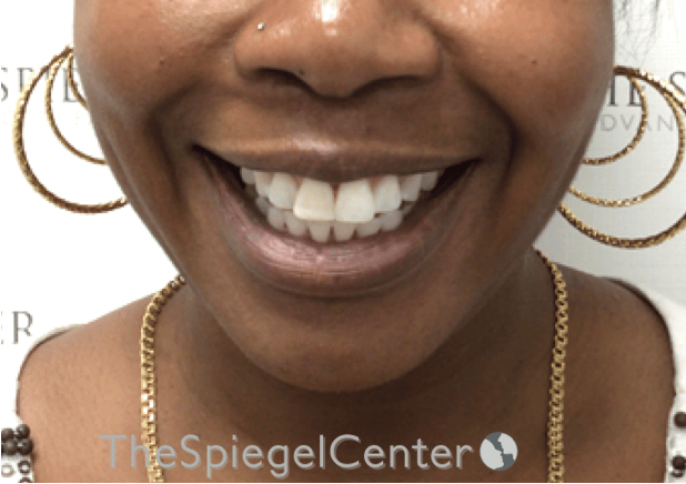 Dimpleplasty Before & After Gallery - Patient 132361 - Image 1