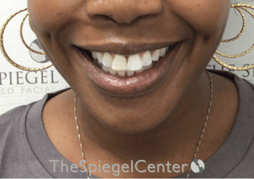 Dimpleplasty Before & After Gallery - Patient 132361 - Image 2