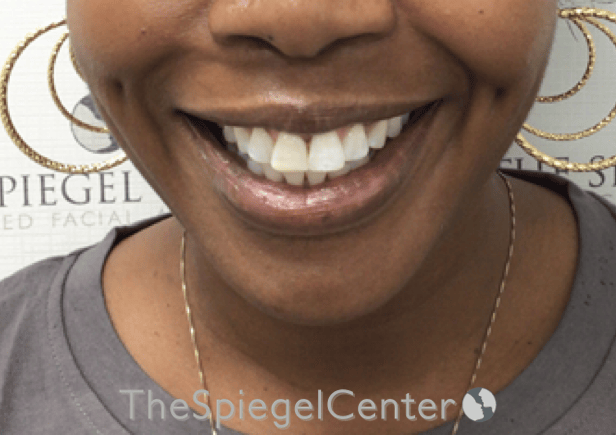 Dimpleplasty Before & After Gallery - Patient 132361 - Image 2