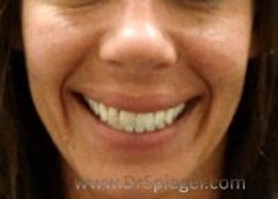 Dimpleplasty Before & After Gallery - Patient 394251 - Image 1