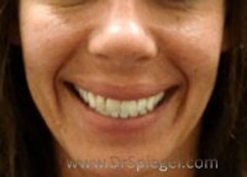 Dimpleplasty Before & After Gallery - Patient 394251 - Image 1