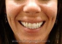 Dimpleplasty Before & After Gallery - Patient 394251 - Image 2