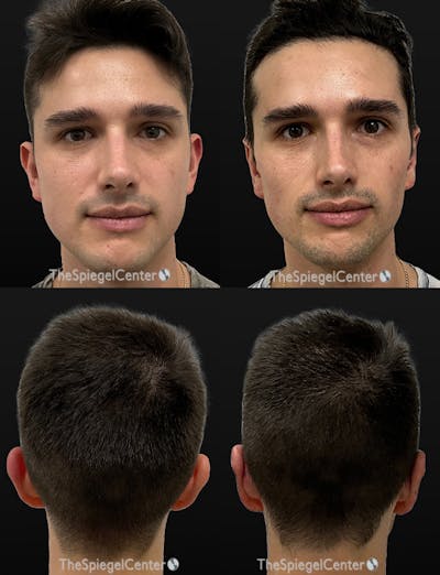 Ear Pinning / Otoplasty Before & After Gallery - Patient 278693 - Image 1