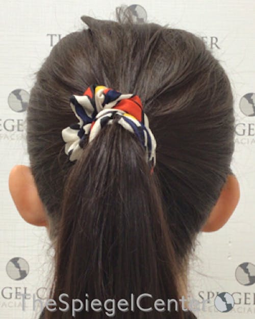 Ear Pinning / Otoplasty Before & After Gallery - Patient 224670 - Image 1