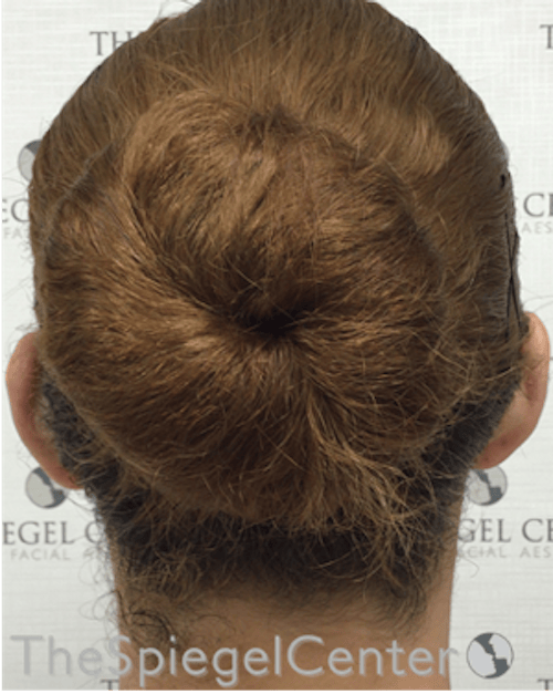 Ear Pinning / Otoplasty Before & After Gallery - Patient 186056 - Image 2