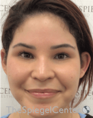 Ear Pinning / Otoplasty Before & After Gallery - Patient 186056 - Image 3