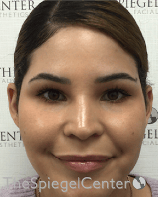 Ear Pinning / Otoplasty Before & After Gallery - Patient 186056 - Image 4