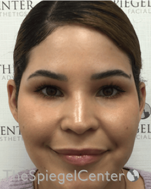 Ear Pinning / Otoplasty Before & After Gallery - Patient 186056 - Image 4