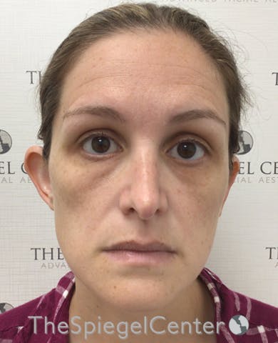 Ear Pinning / Otoplasty Before & After Gallery - Patient 172652 - Image 3