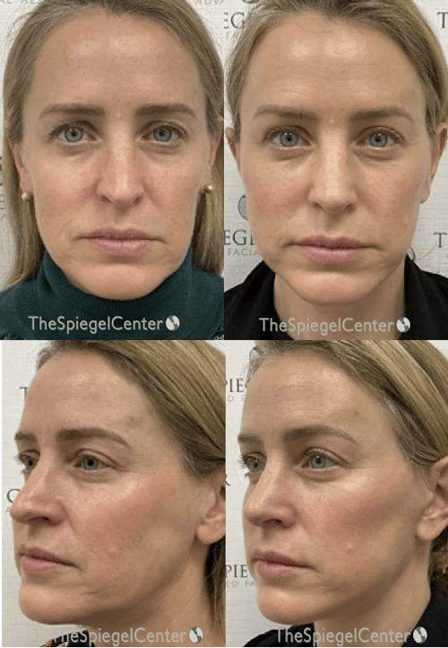 Facelift Before & After Gallery - Patient 358435 - Image 1