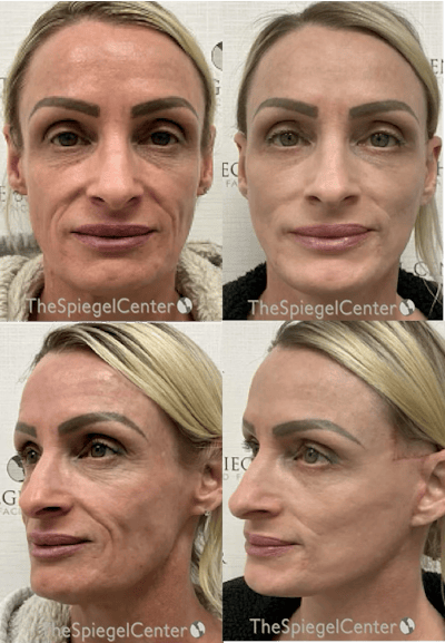 Facelift Before & After Gallery - Patient 444980 - Image 1
