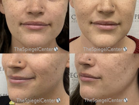 Facial Fat Grafting Before & After Gallery - Patient 183829 - Image 1