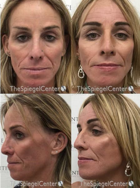 Facial Fat Grafting Before & After Gallery - Patient 602118 - Image 1